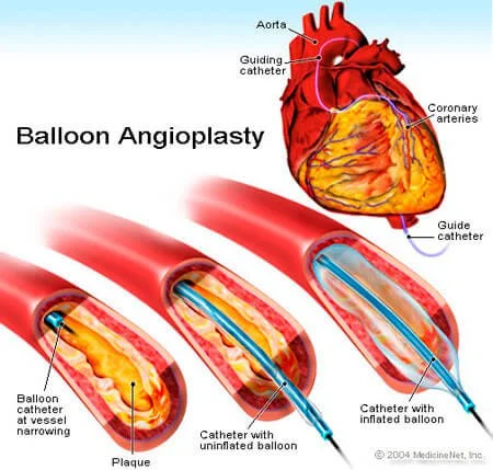 Angioplasty | Rythm Heart Clinic