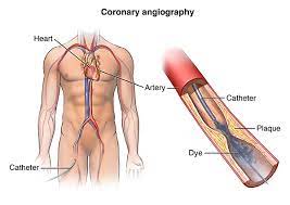 Angioplasty